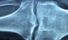 Semnele artritei inflamatorii - cum o poti trata?