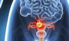 Teste de diagnostic pentru cancerul de col uterin