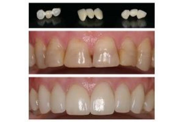 Premium Dental - Clinica de estetica dentara - lava_restorations.jpg