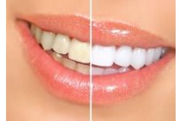 Premium Dental - Clinica de estetica dentara - theeth-whitening-before-and-after.jpg