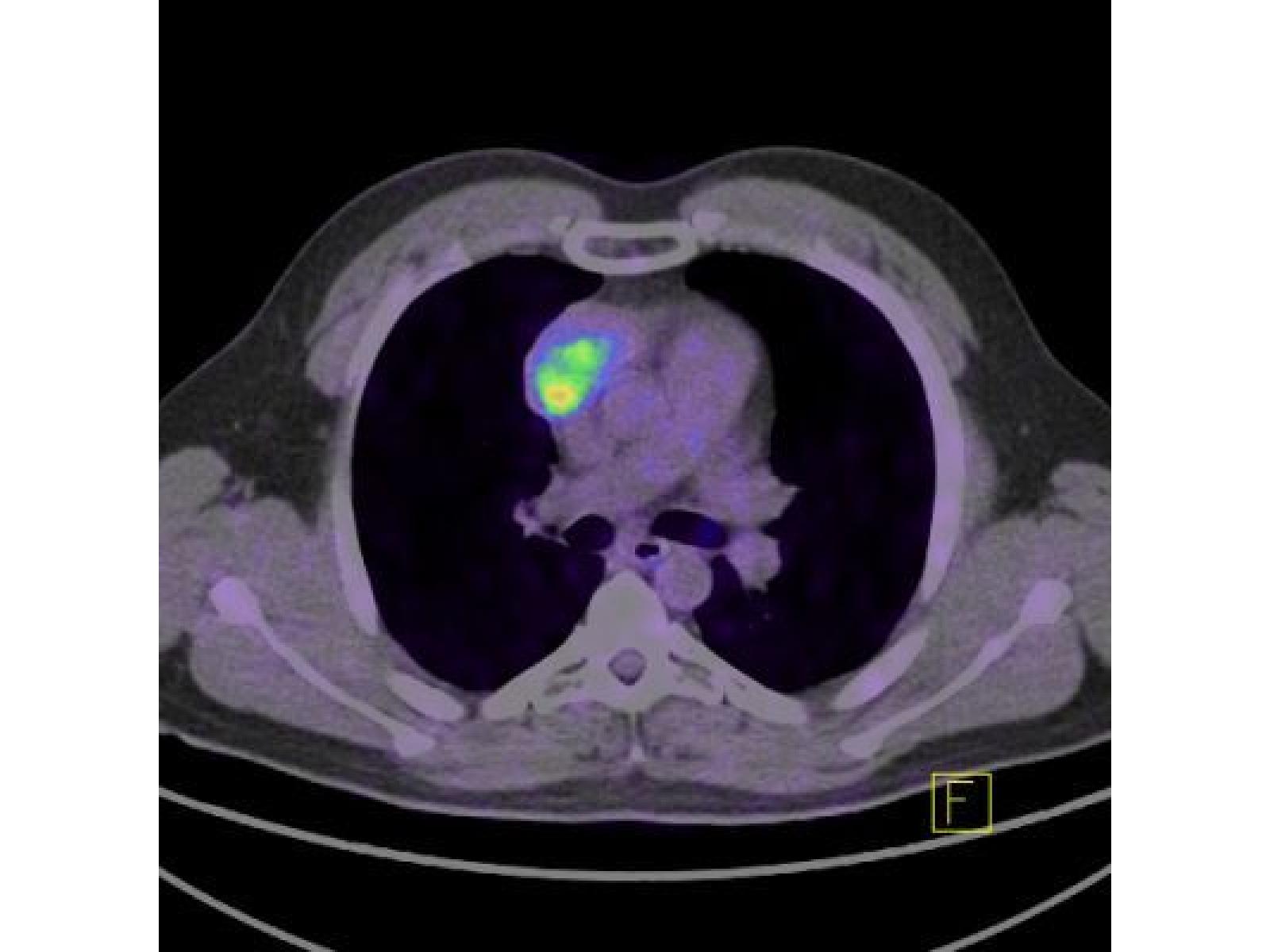 Centrul de Diagnostic Pozitron Diagnosztika PET CT - PET_CT.jpg