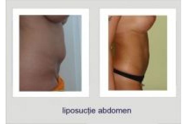 Dr. Lucian Fodor - liposuctie_abdomen2.jpg