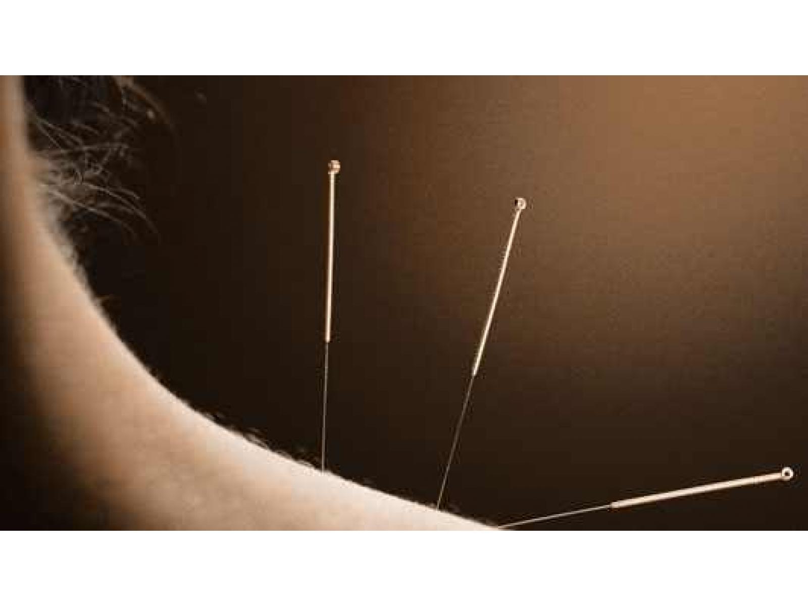 LEON CLINIQUE - acupuncture_41447900.jpg
