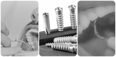 Cum stii ca ai ales cea mai buna clinica pentru implant dentar