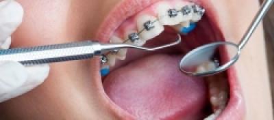 Aparat dentar? Cand, de ce si care vi se potriveste cel mai bine