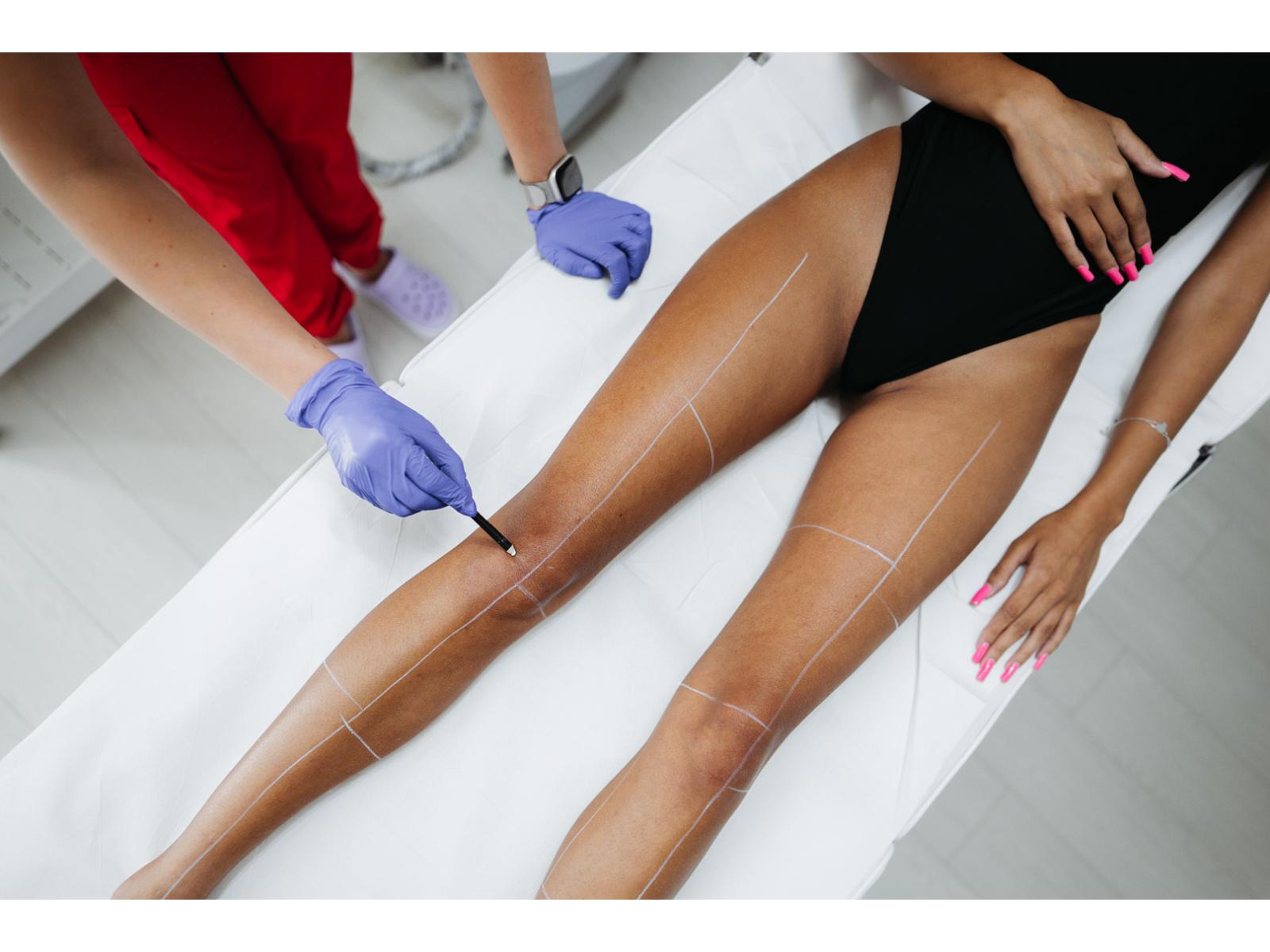 Episculpt Beauty Sibiu - delimitare-zone-epilare-definitiva-laser-episculpt-beauty-sibiu.jpg