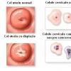 Cancerul cervical - stadializare si tratament