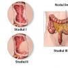 Cancerul colorectal recurent si metastatic