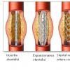 Infarctul miocardic si angina instabila