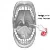Amigdalita - inflamatia amigdalelor