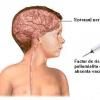 Vaccinarea antipoliomielita (vaccinare inclusa in programul national de imunizari)