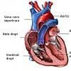 Insuficienta cardiaca