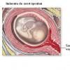 Avortul spontan - pierderea spontana a sarcinii