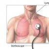 Sindromul respirator acut sever (SRAS)