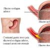 Arsurile gastrice, hernia hiatala si boala  de reflux gastroesofagian (GERD