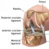 Condromalacia patelara (rotuliana) – o afectiune a cartilajului genunchiului