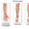 Fracturile diafizare ale oaselor antebratului