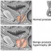 Adenomul de prostata