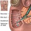 Cancerul ductului biliar extrahepatic