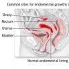 Endometrioza - proliferare endometru