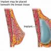 Operatia de marire a sanilor sau mamoplastia