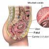 Punctia trofoblastica – Metoda invaziva de diagnostic