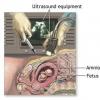 Amniocenteza – Metoda invaziva de diagnostic