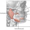 Infectiile glandelor salivare - sialadenitele