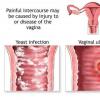 Durerea ce apare in timpul contactului sexual (dispareunia)