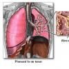 Pneumonia comunitara