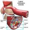 Lupusul eritematos sistemic - generalitati