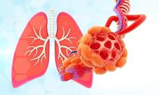 Explorarea bolilor rare pulmonare: prezentare, diagnostic si tratament
