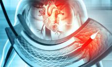 Cardiomiopatia dilatativa