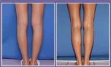Implanturile de gambe, un nou trend in chirurgia estetica – 1 din 10 femei opteaza pentru o astfel de interventie