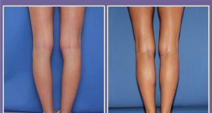 Implanturile de gambe, un nou trend in chirurgia estetica – 1 din 10 femei opteaza pentru o astfel de interventie