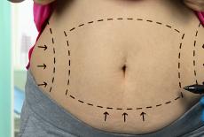 Abdominoplastia, solutia rapida pentru un abdomen atractiv