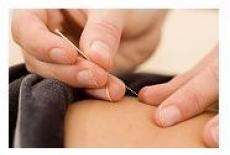 Acupunctura si beneficiile sale