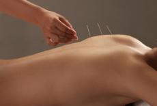 Cum functioneaza si ce este acupunctura?