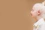 Ce complicatii pot aparea in cazul albinismului?