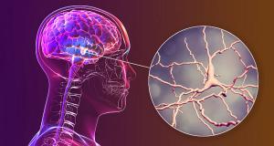 Boala Parkinson - descriere, simptome, tratament