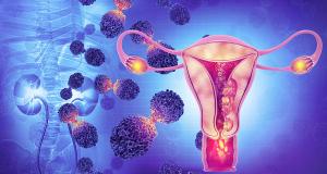 Cancerul endometrial