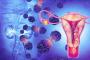 Cancerul endometrial