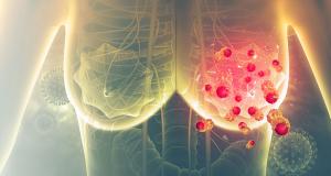 De ce recidiveaza cancerul mamar