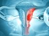 Cancerul ovarian, neoplasmul cu cea mai mica rata de supravietuire in randul femeilor