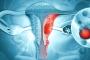 Cancerul ovarian, neoplasmul cu cea mai mica rata de supravietuire in randul femeilor