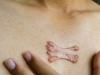 Cicatricile cheloide pot reprezenta un pericol pentru sanatate?