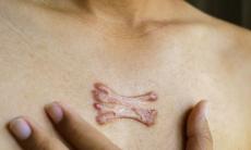 Cicatricile cheloide pot reprezenta un pericol pentru sanatate?