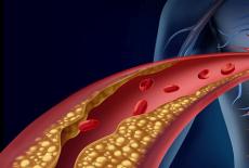 Dislipidemia - un real pericol pentru cardiaci