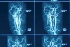 Ecografia Doppler vasculara 