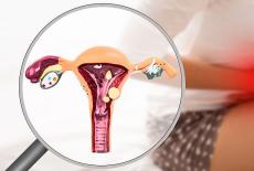 Endometrioza la adolescente